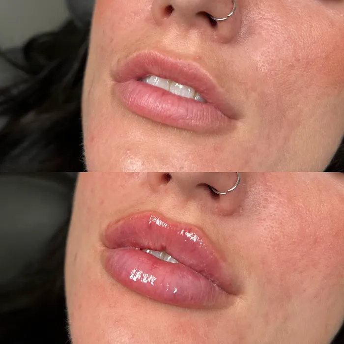 Caleb Martin, Austin Nurse Injector - Advanced Botox & Filler Picture 5