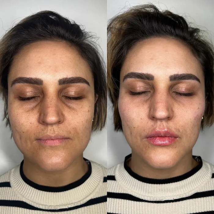 Caleb Martin, Austin Nurse Injector - Advanced Botox & Filler Picture 3