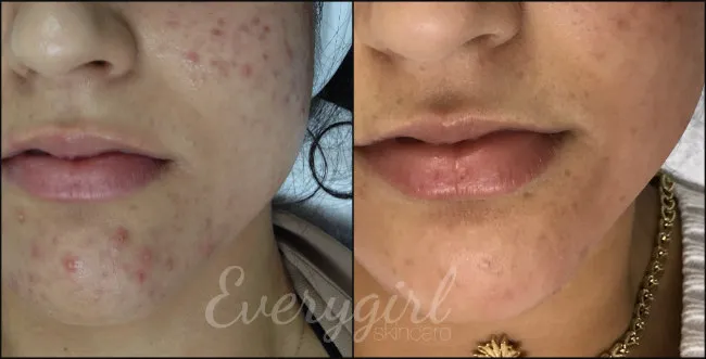 Everygirl Skincare and Acne Clinic Picture 3