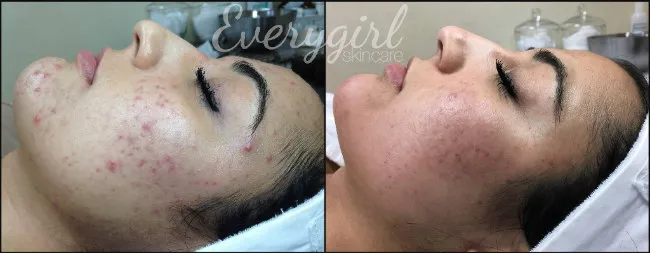 Everygirl Skincare and Acne Clinic Picture 7