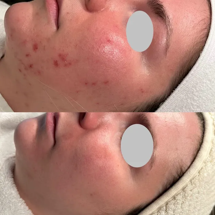 E Aesthetics and Acne Care Picture 7