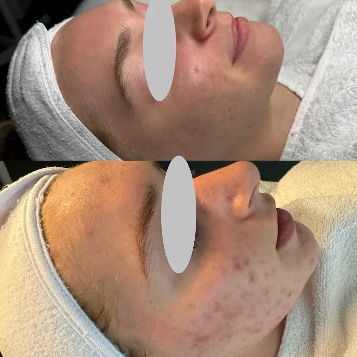 E Aesthetics and Acne Care Picture 8