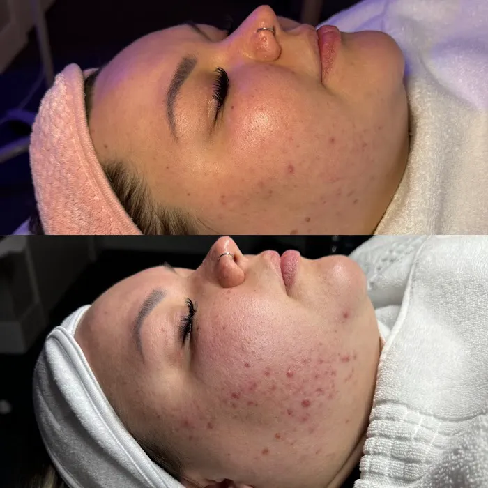 E Aesthetics and Acne Care Picture 10