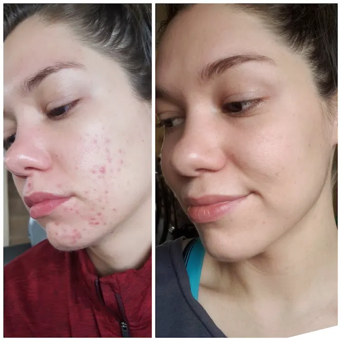 Clear Skin America Picture 9