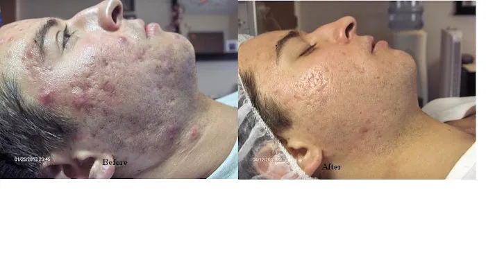 Tucson Acne Clinic Picture 1