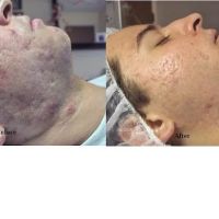 Tucson Acne Clinic ico