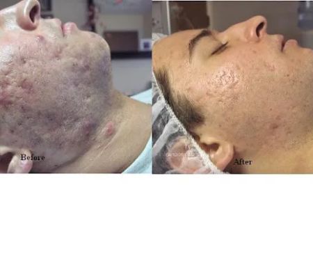 Tucson Acne Clinic