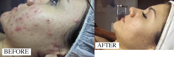 Tucson Acne Clinic Picture 2