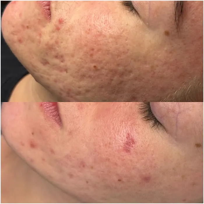 Skinventure - Tucson Acne Specialist Picture 5
