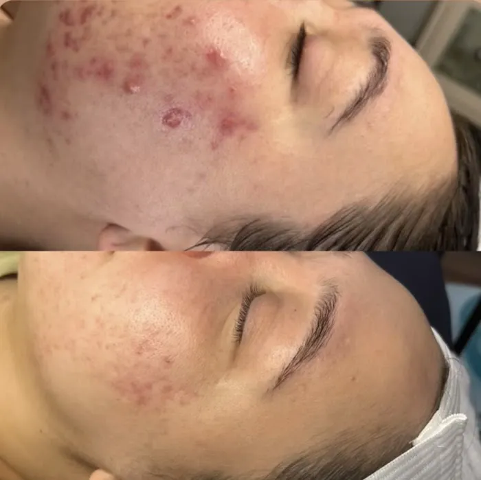 Skinventure - Tucson Acne Specialist Picture 4