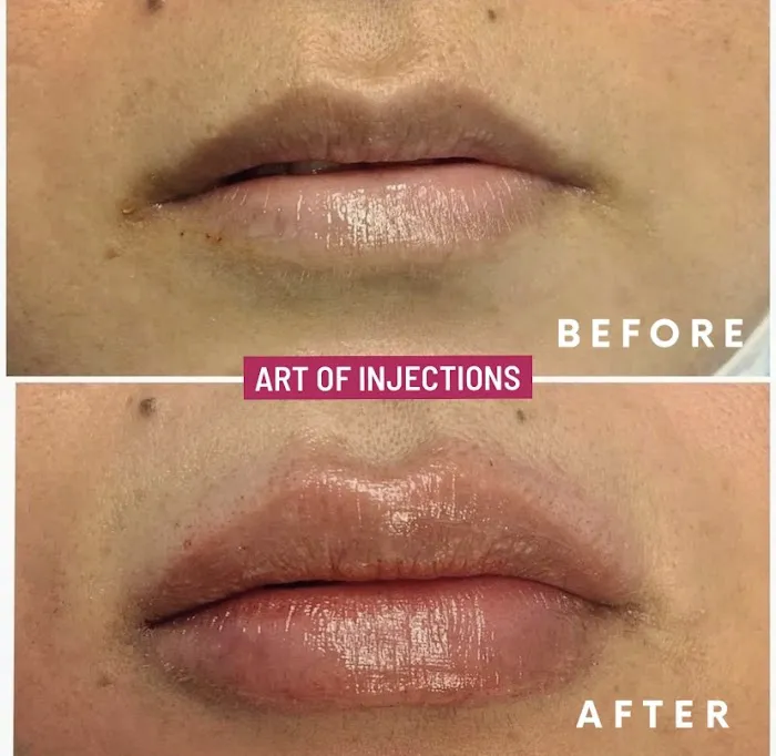 Art Of Injections Picture 5