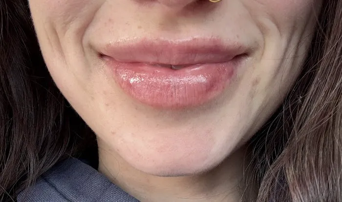 Art Of Injections Picture 4