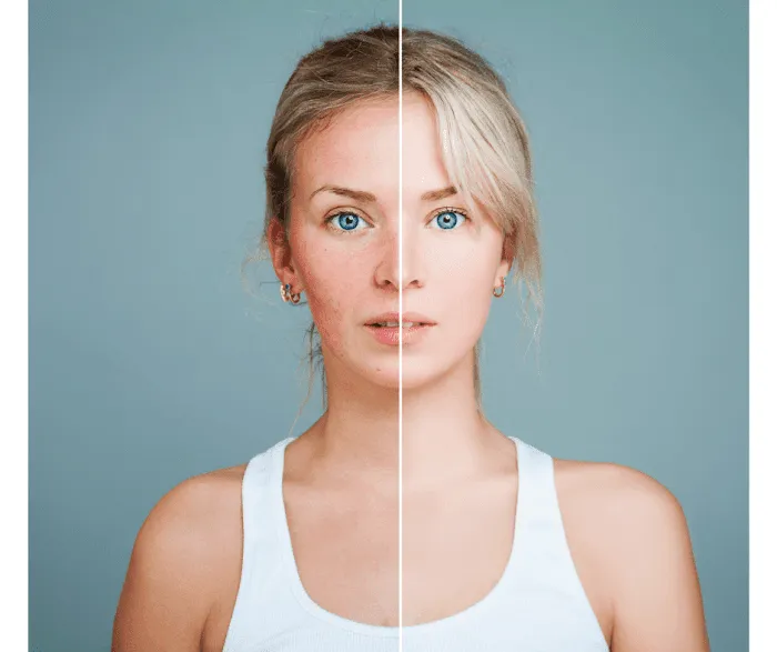 Reveal Cosmetic Laser Picture 2