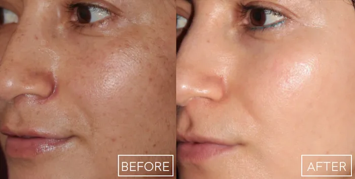 Reveal Cosmetic Laser Picture 6