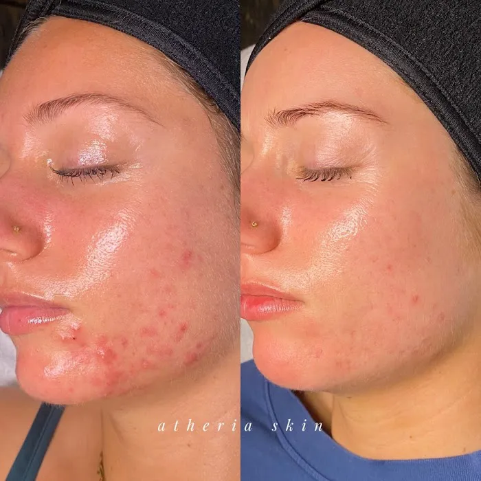 Atheria Skin Picture 5