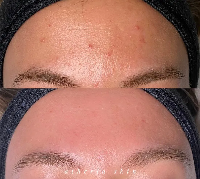 Atheria Skin Picture 9