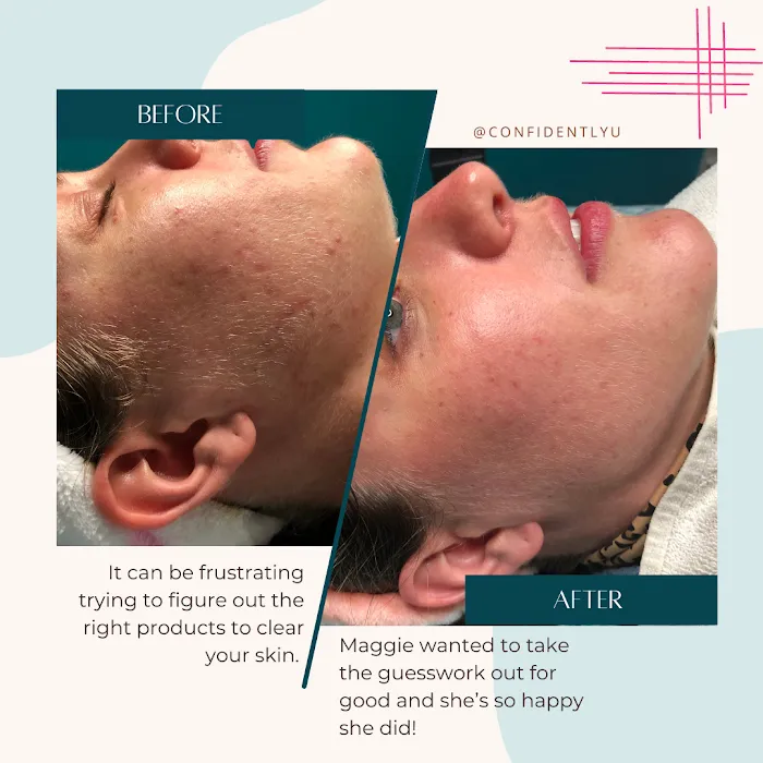 Confidently You Acne Care Picture 3