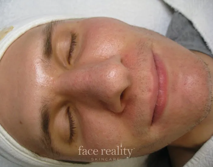 Amira Acne Solutions Picture 1
