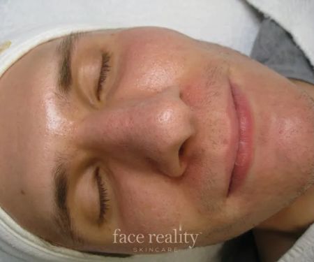 Amira Acne Solutions