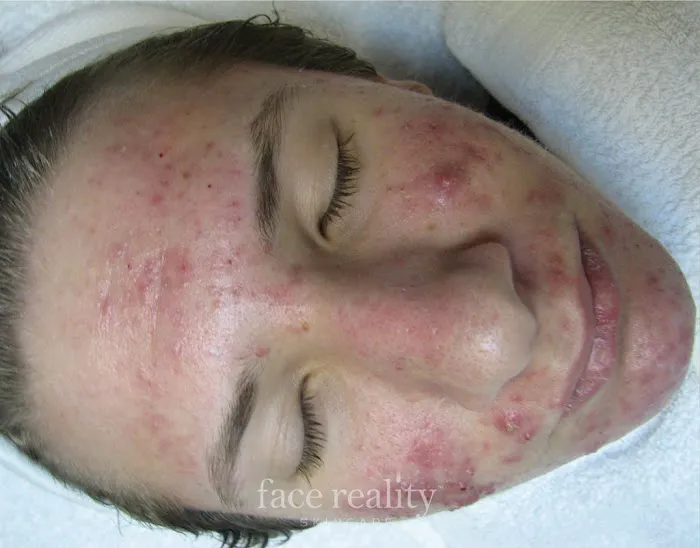 Amira Acne Solutions Picture 2