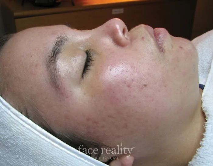 Amira Acne Solutions Picture 3