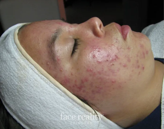 Amira Acne Solutions Picture 5