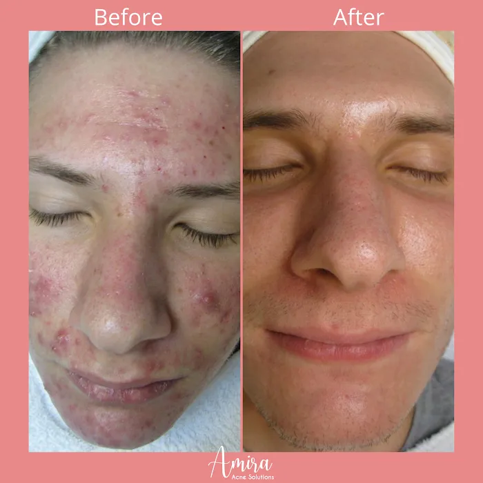 Amira Acne Solutions Picture 10
