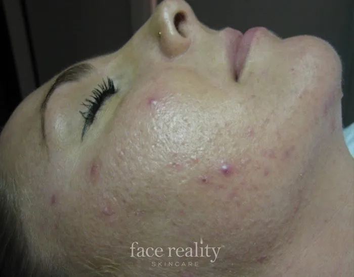 Amira Acne Solutions Picture 7