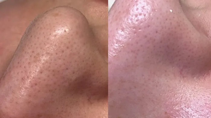 Skin Nova Seattle Picture 2