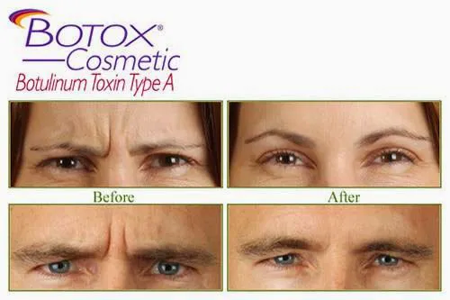 Botox Botixue Picture 3