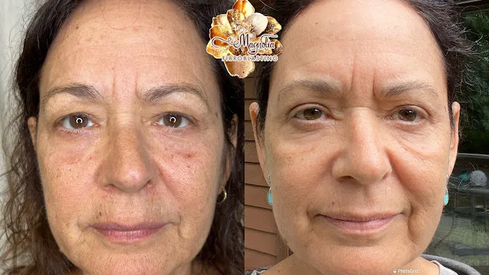 Magnolia Plasma Fibroblasting Picture 3