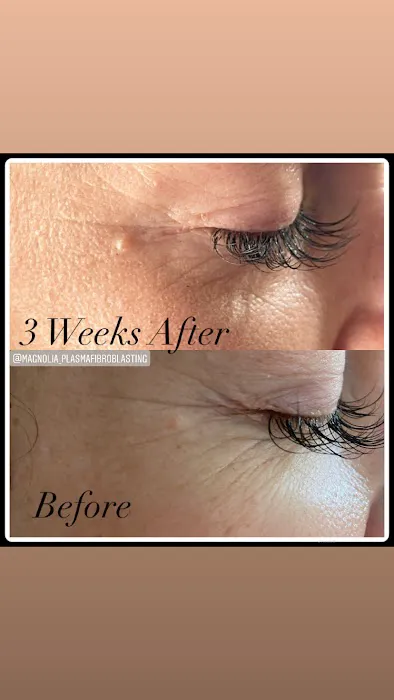 Magnolia Plasma Fibroblasting Picture 2