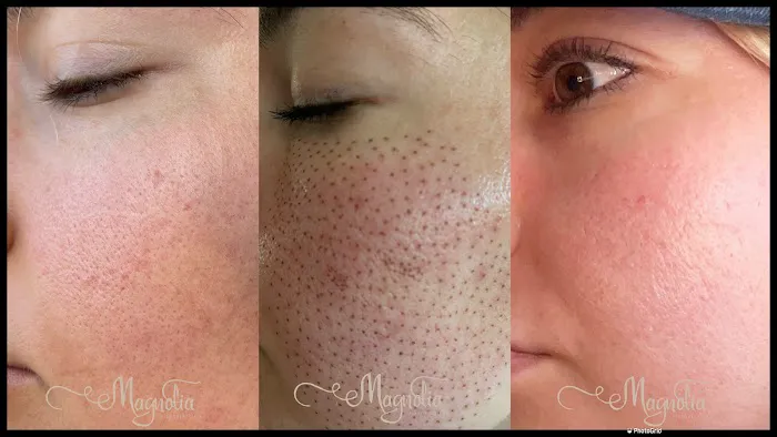 Magnolia Plasma Fibroblasting Picture 1