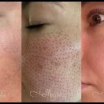 Magnolia Plasma Fibroblasting