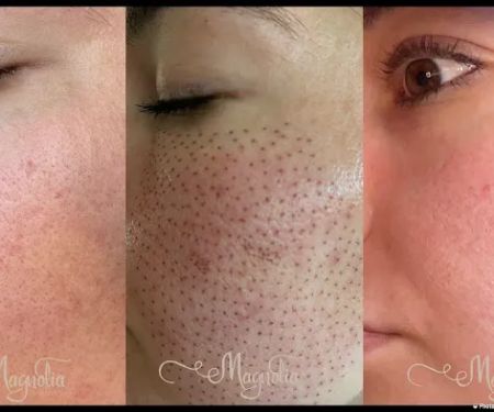 Magnolia Plasma Fibroblasting