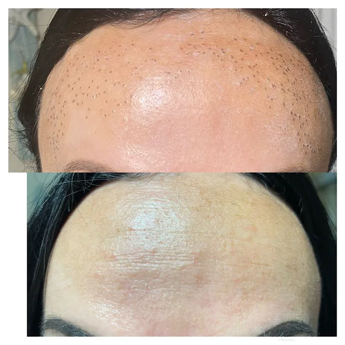 Magnolia Plasma Fibroblasting Picture 4