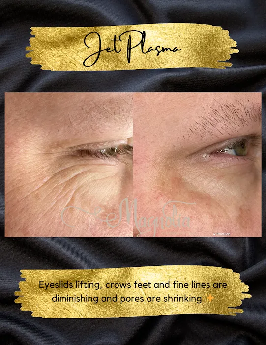 Magnolia Plasma Fibroblasting Picture 5