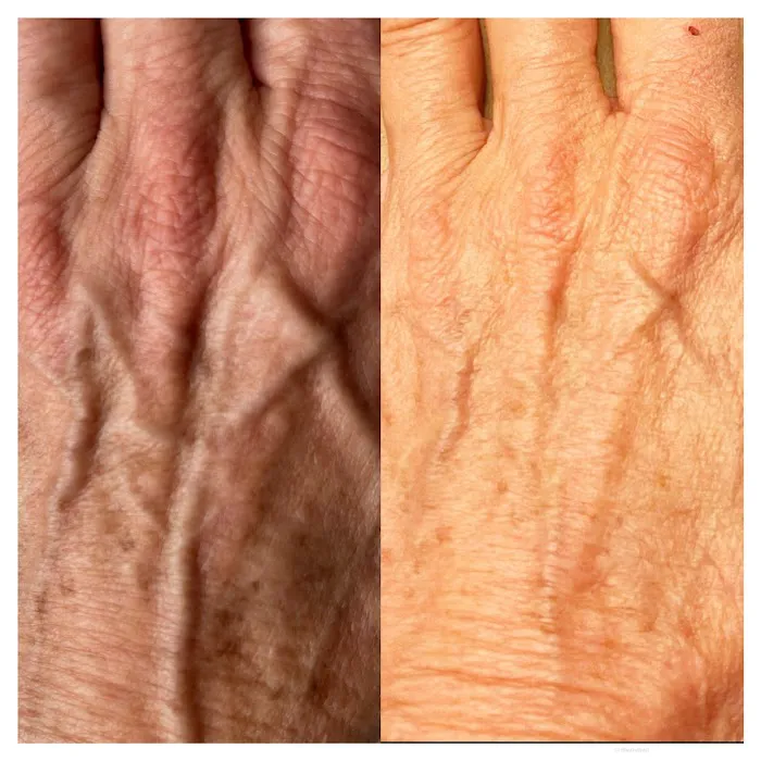 Magnolia Plasma Fibroblasting Picture 9