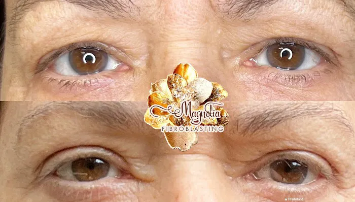 Magnolia Plasma Fibroblasting Picture 10