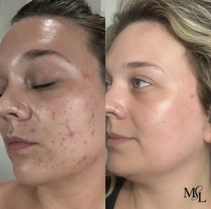 Modern Skin Lab - Dallas Facials | Microneedling | Certified Acne Expert Picture 8