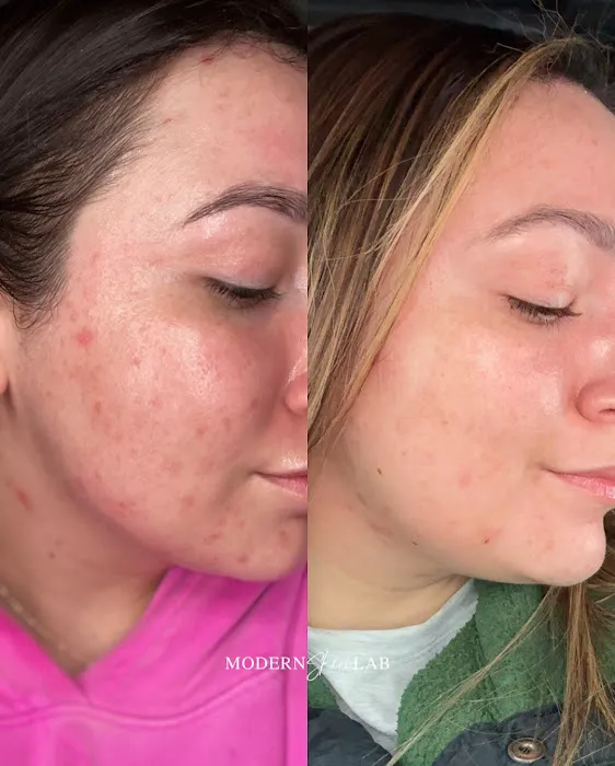 Modern Skin Lab - Dallas Facials | Microneedling | Certified Acne Expert Picture 9