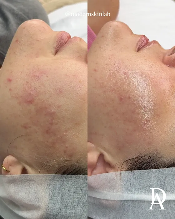 Modern Skin Lab - Dallas Facials | Microneedling | Certified Acne Expert Picture 10