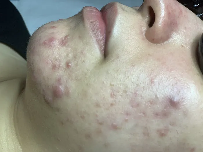 Clear Beauty Acne Clinic Picture 5