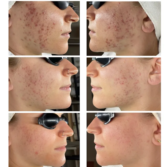Acne Specialists of Long Beach Picture 5