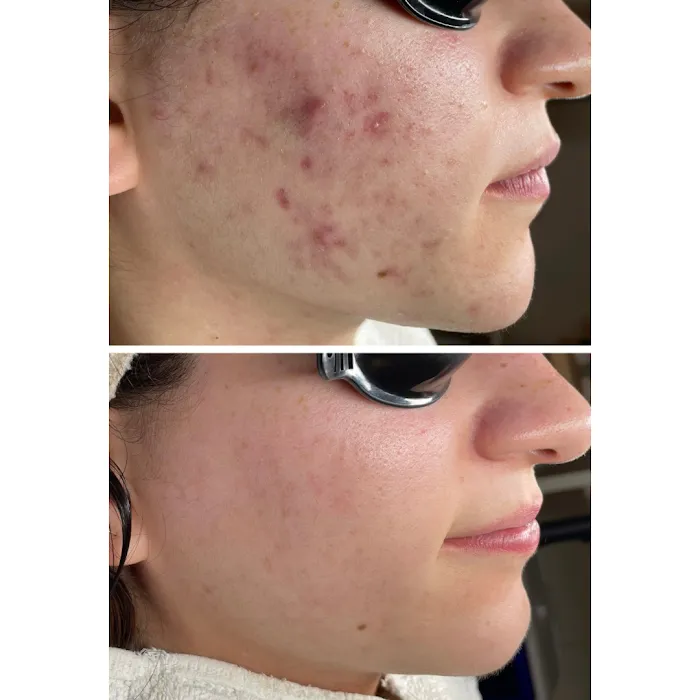 Acne Specialists of Long Beach Picture 4