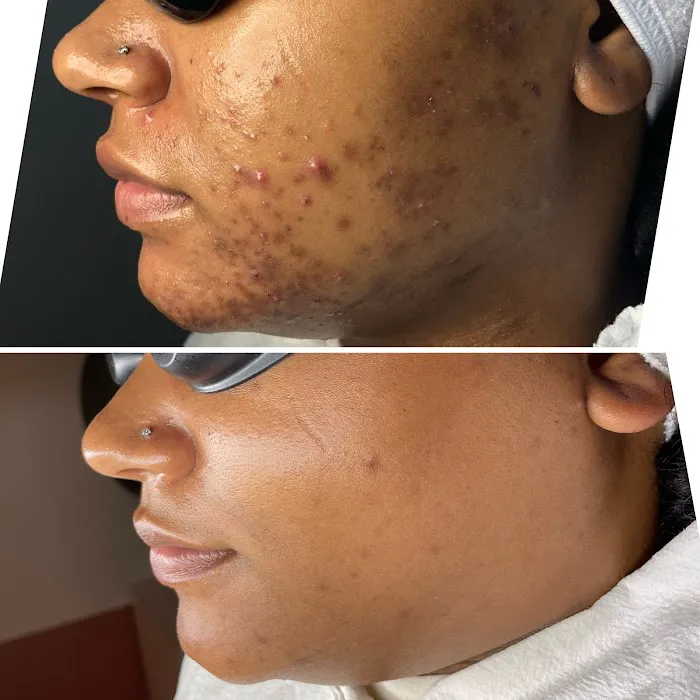 Acne Specialists of Long Beach Picture 7