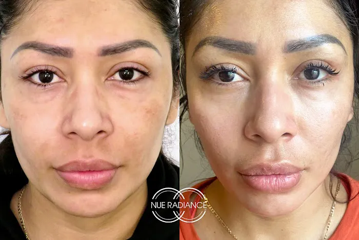 Nue Radiance - Jet Plasma and Fibroblast Treatments & Training Picture 3