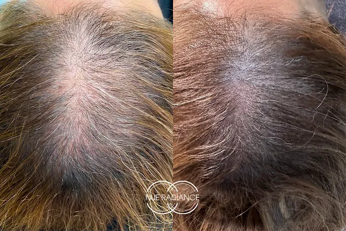 Nue Radiance - Jet Plasma and Fibroblast Treatments & Training Picture 1