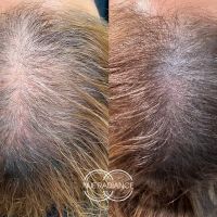 Nue Radiance - Jet Plasma and Fibroblast Treatments & Training ico