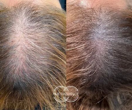 Nue Radiance - Jet Plasma and Fibroblast Treatments & Training